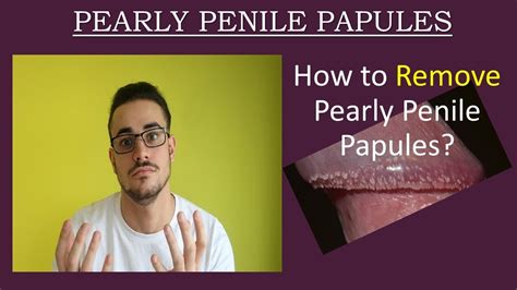 papulas perladas|Pearly penile papules